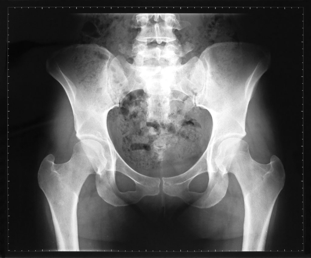 An AP X ray of the pelvis illustrating the ball and socket of the hip joint 